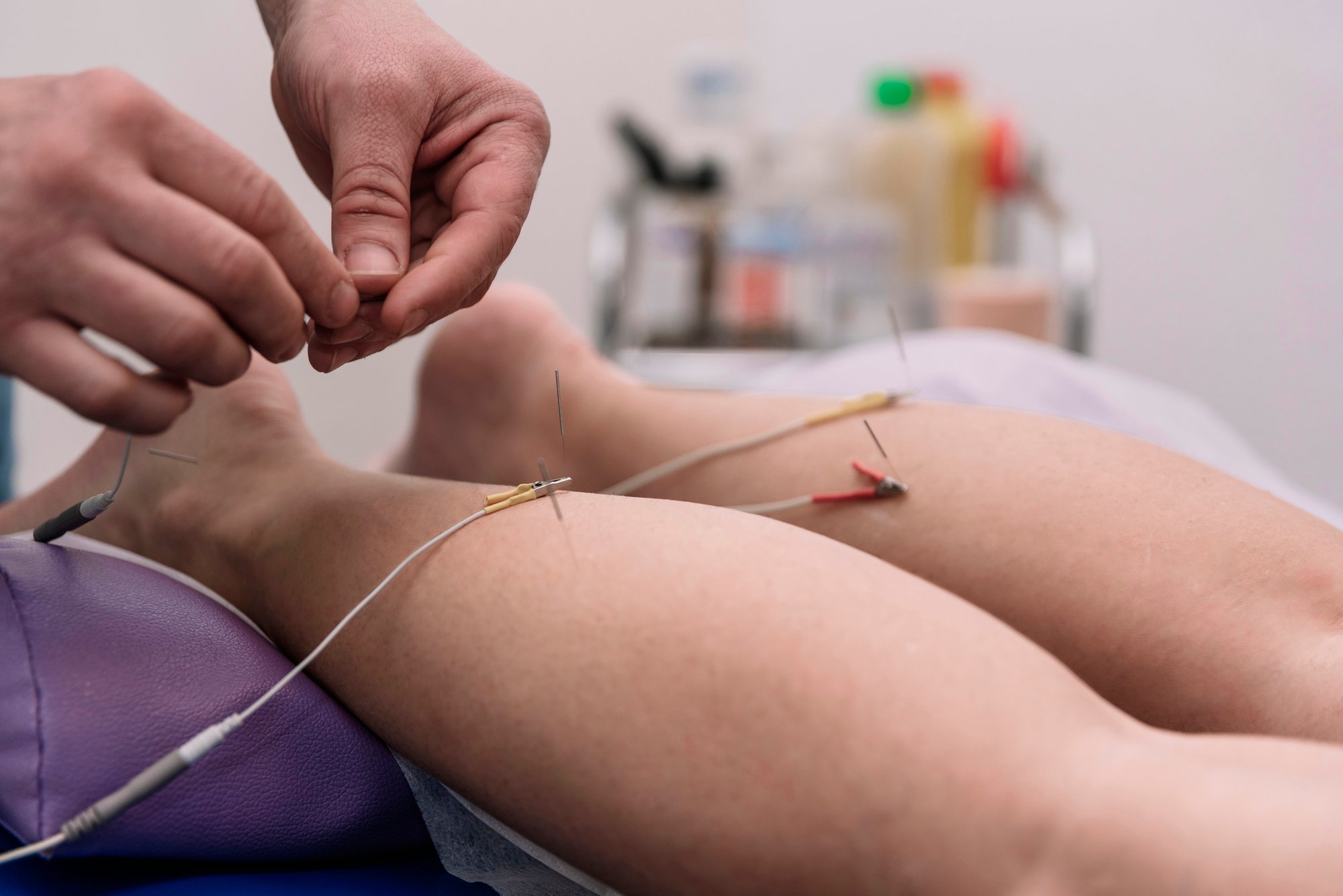 Dry Needling Calves of Patient