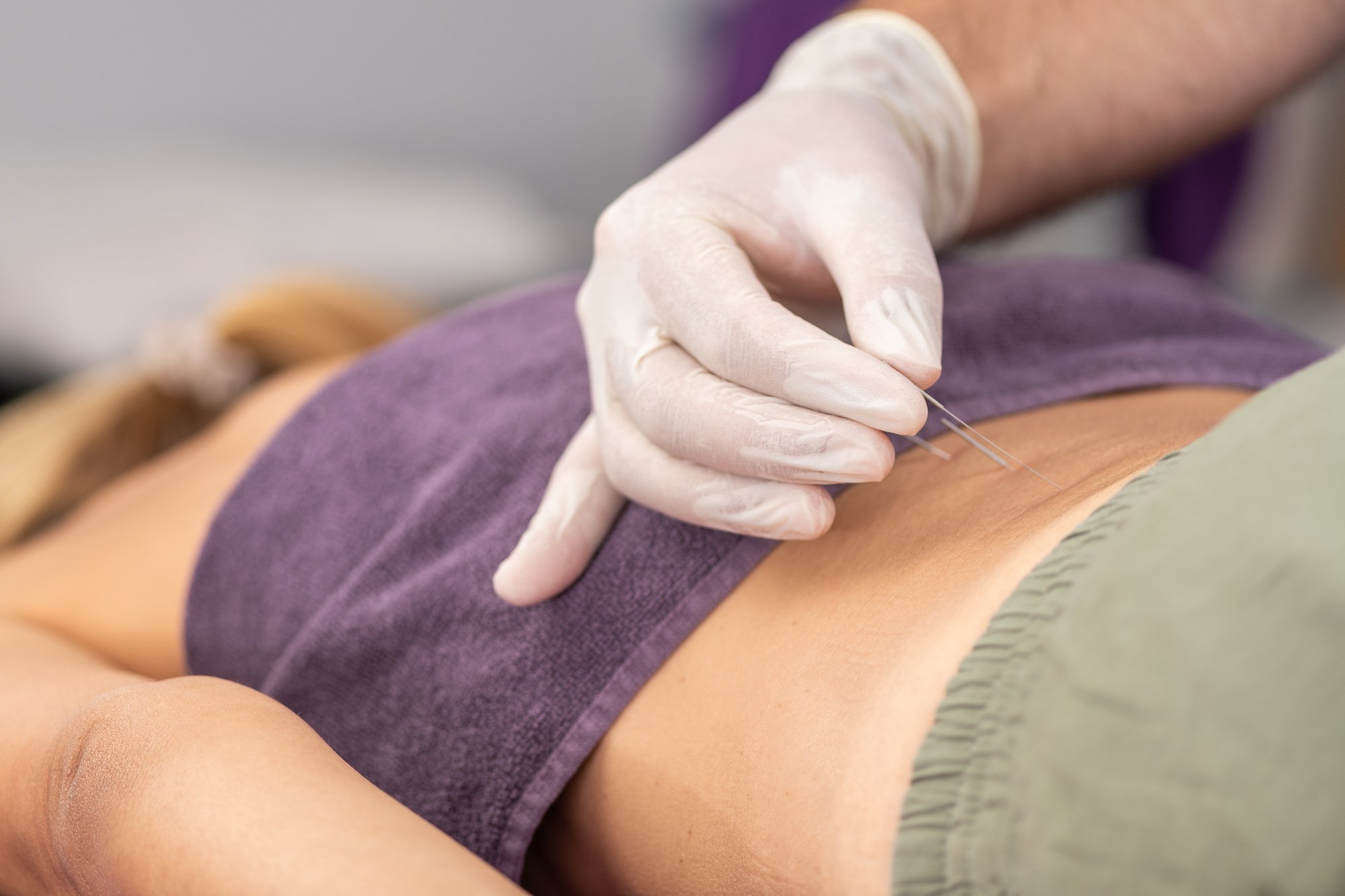 Targeted Dry Needling for pain relief