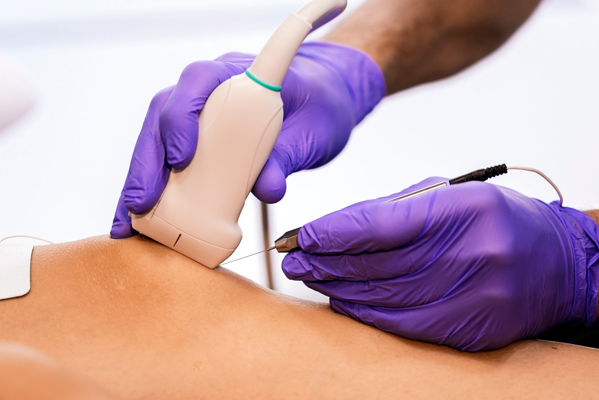 Physical Therapist Dry Needling Knee