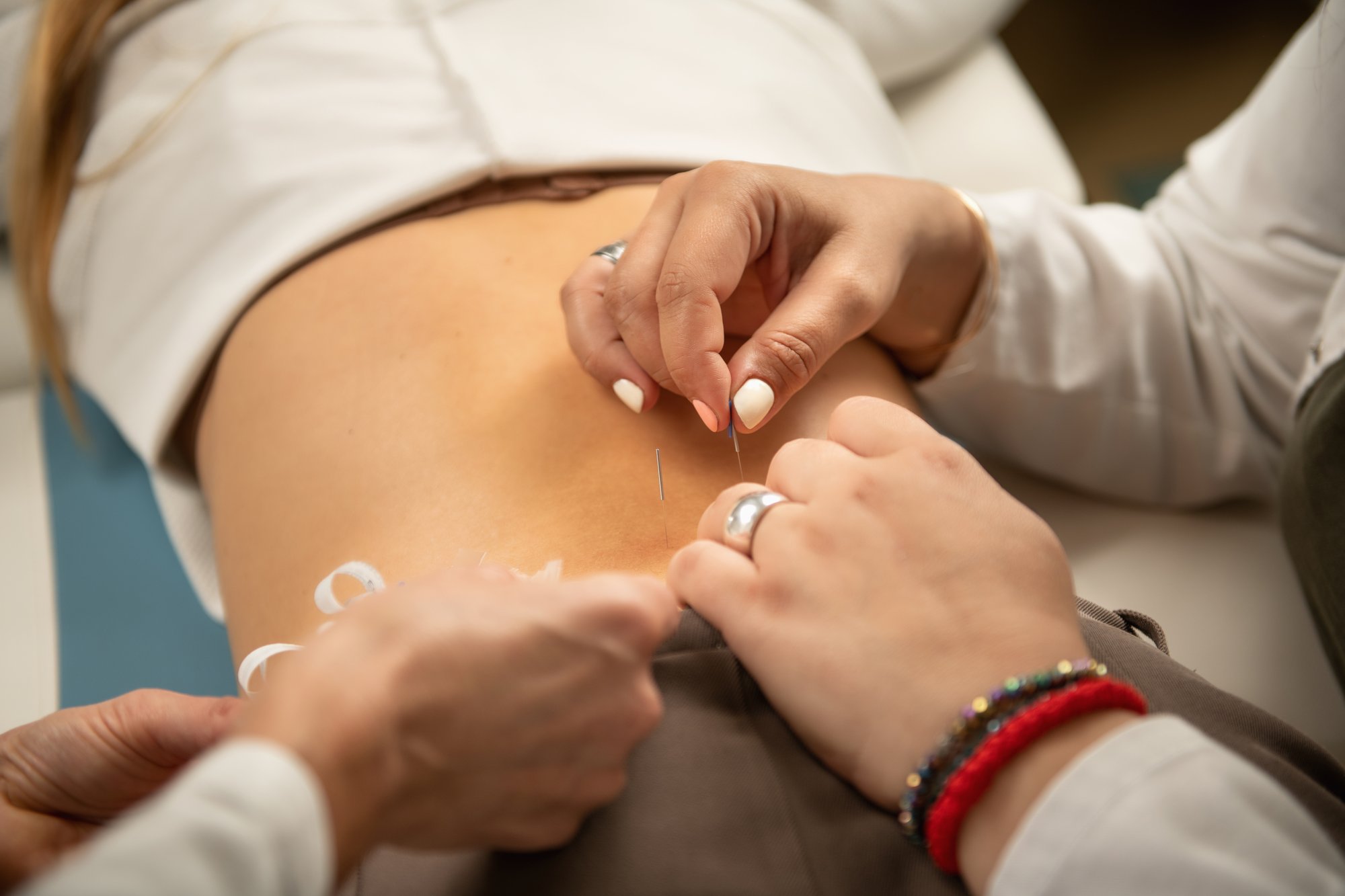 Dry Needling Lower Back